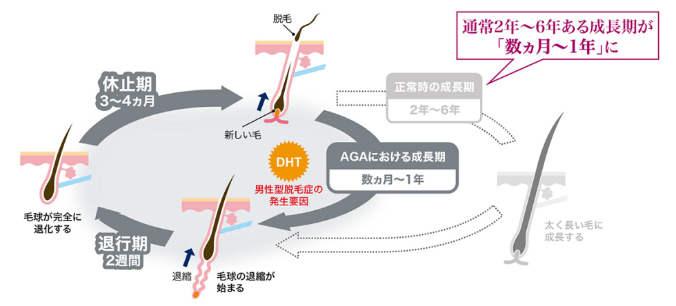 AGA男性のヘアサイクル 図
